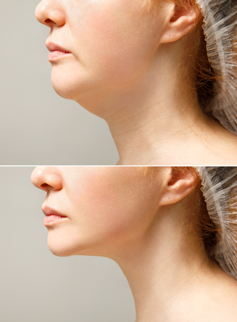 What are the benefits and risks of Kybella?